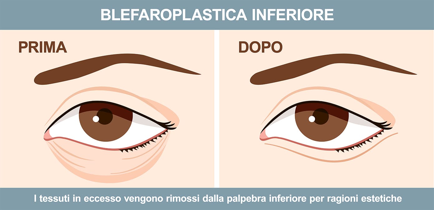 blefaroplastica-inferiore-ponticello