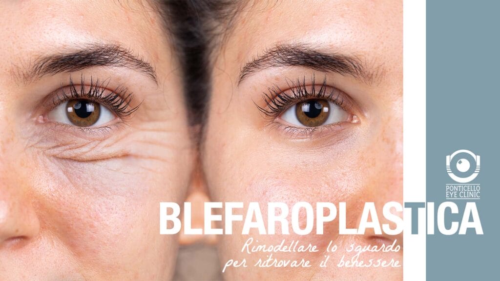 blefaroplastica-ponticello-wide