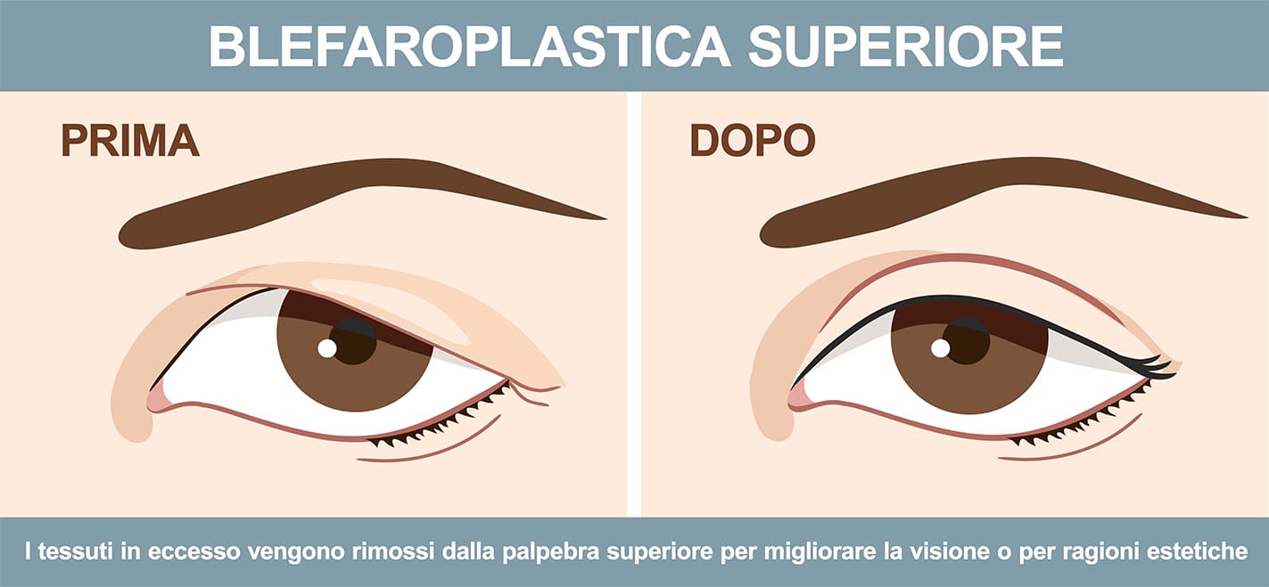 blefaroplastica-superiore-ponticello