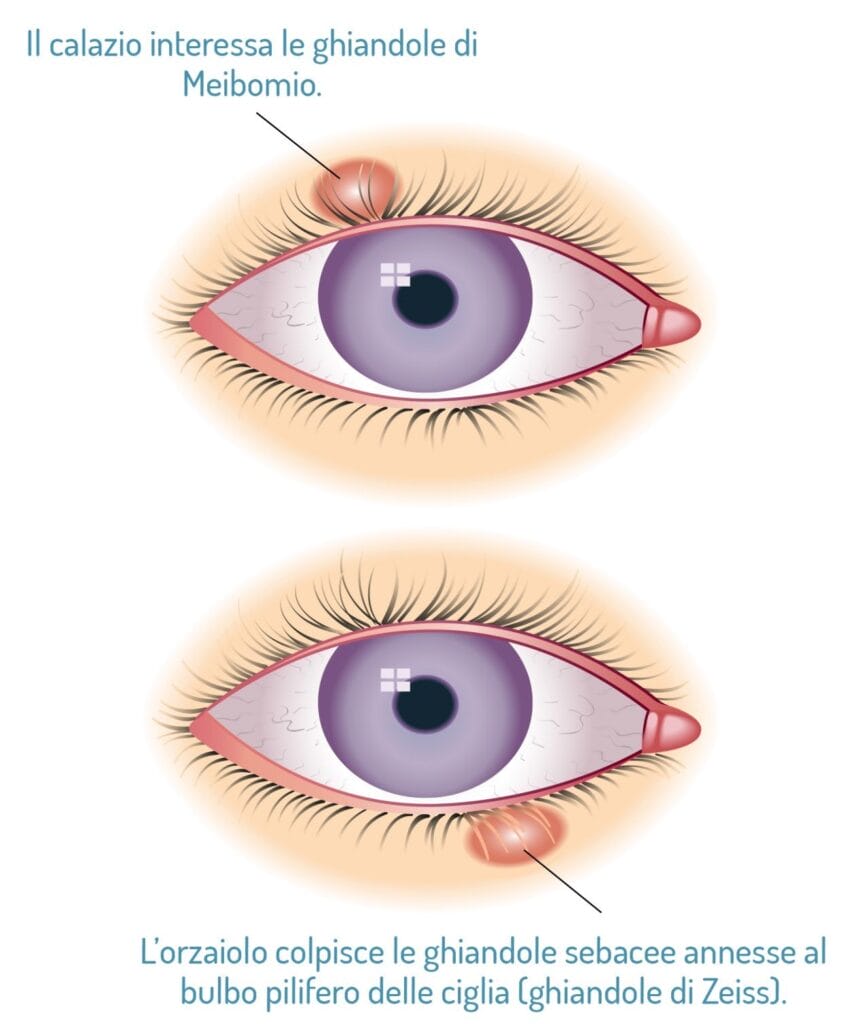 orzaiolo-calazio-differenze-eye-clinic
