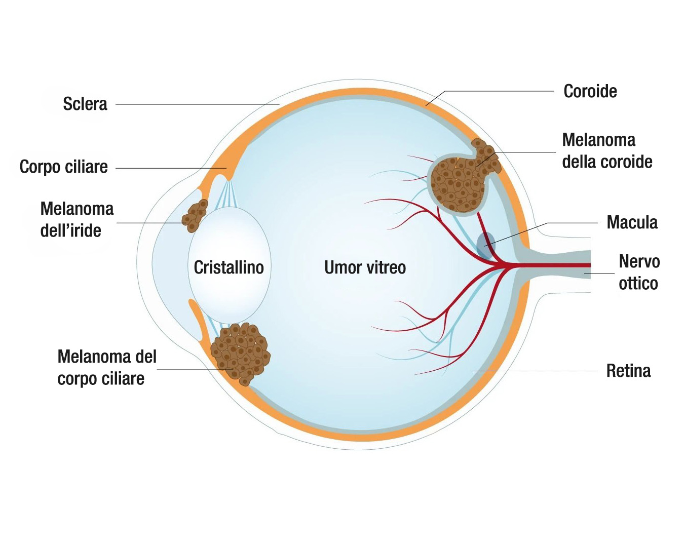 melanoma-oculare-ponticello-eye-clinic-massa