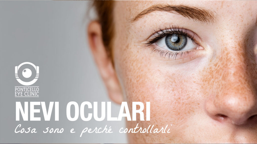 nevi-oculari-ponticello-eye-clinic-massa-carrara
