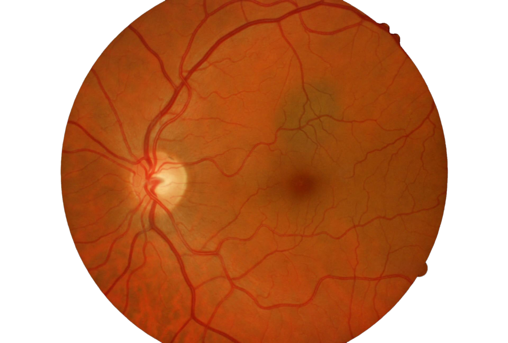 nevo-coroidale-fundus
