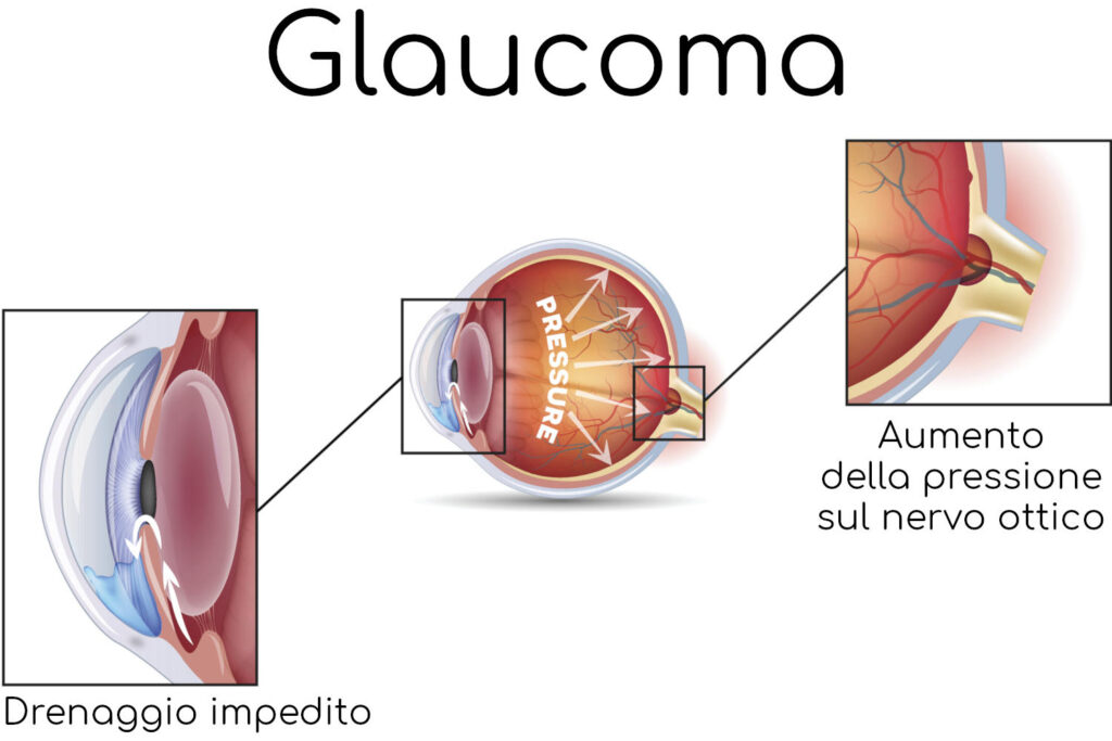 glaucoma-e-neuroprotezione-ponticello-eye-clinic-anatomia